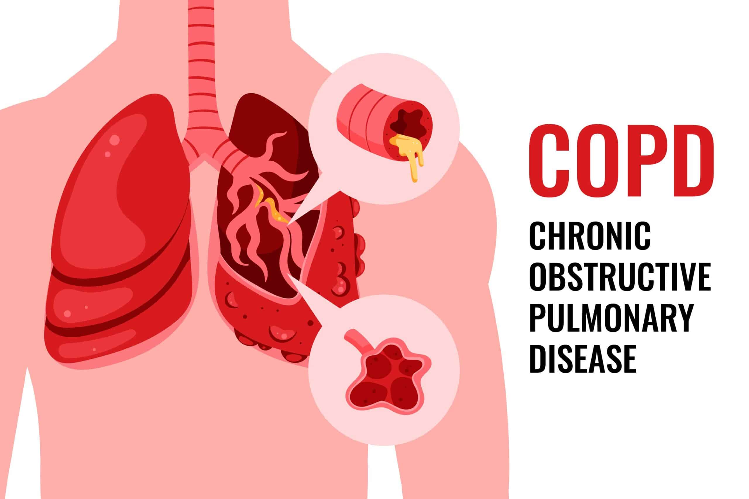 COPD – Overview, Causes, Symptoms and Treatment in Nepal