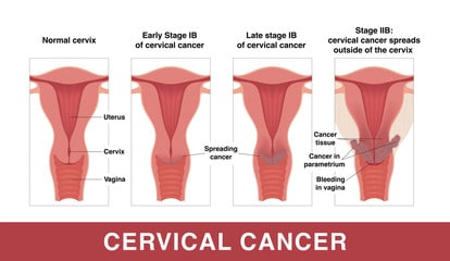 HPV Infection and Cervical Cancer