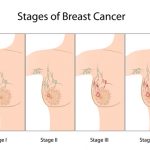 Breast Cancer stages