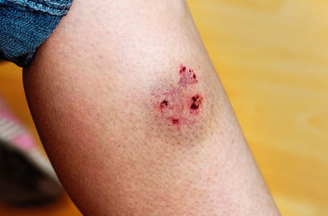 Level of dog bite pictures | Treatment of dog bite