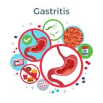 Gastritis: Causes, Risk and Prevention in Nepal