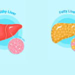 fatty liver causes in Nepal