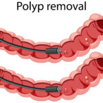 Polyp removal, polypectomy in Kathmandu