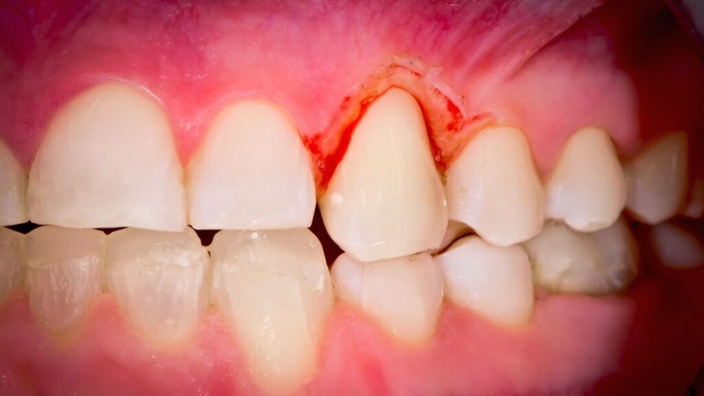 Gingivitis, gum disease