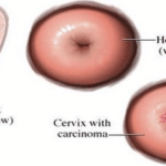 cervical cancer detection in Nepali women