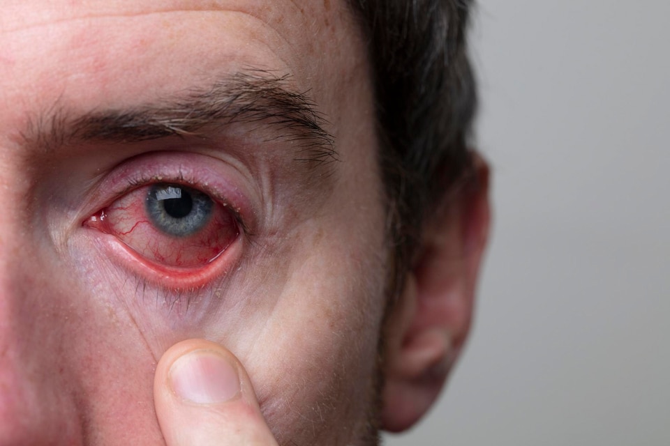 What to Do When You Are Suffering from Viral Eye Conjunctivitis(Pink Eye)?